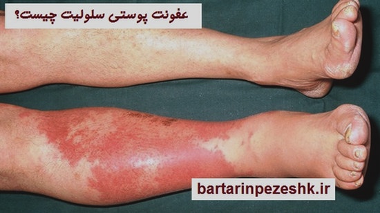 بیماری ها و حساسیت های پوستی عفونت پوستی سلولیت چیست؟