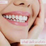 بلیچینگ دندان در شرق تهران سفید کردن دندان به روش بلیچینگ