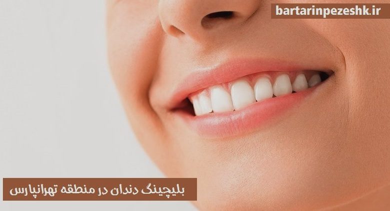 بلیچینگ دندان در تهرانپارس