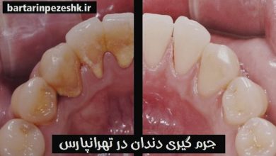 جرم گیری دندان در تهرانپارس