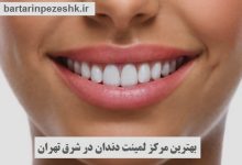 لمینت دندان در شرق تهران
