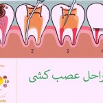 عصب کشی دندان در دندانپزشکی چگونه انجام میشود.