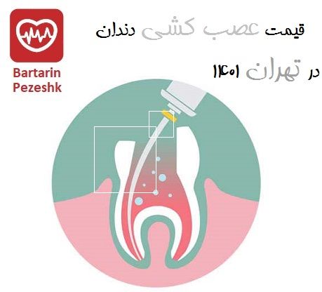 قیمت عصب کشی دندان در تهران 1401