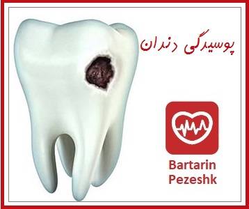 پوسیدگی دندان و عصب کشی دندان در غرب تهران