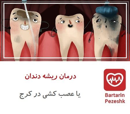 درمان ریشه دندان یا عصب کشی در کرج 