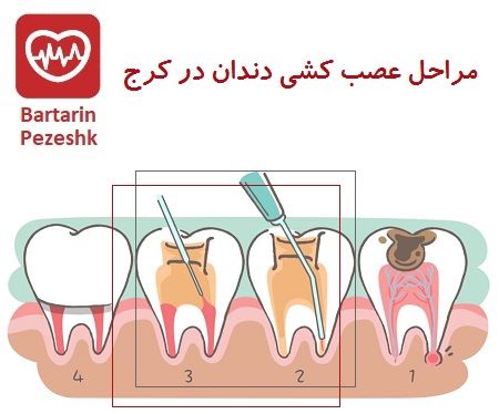 مراحل عصب کشی دندان در کرج