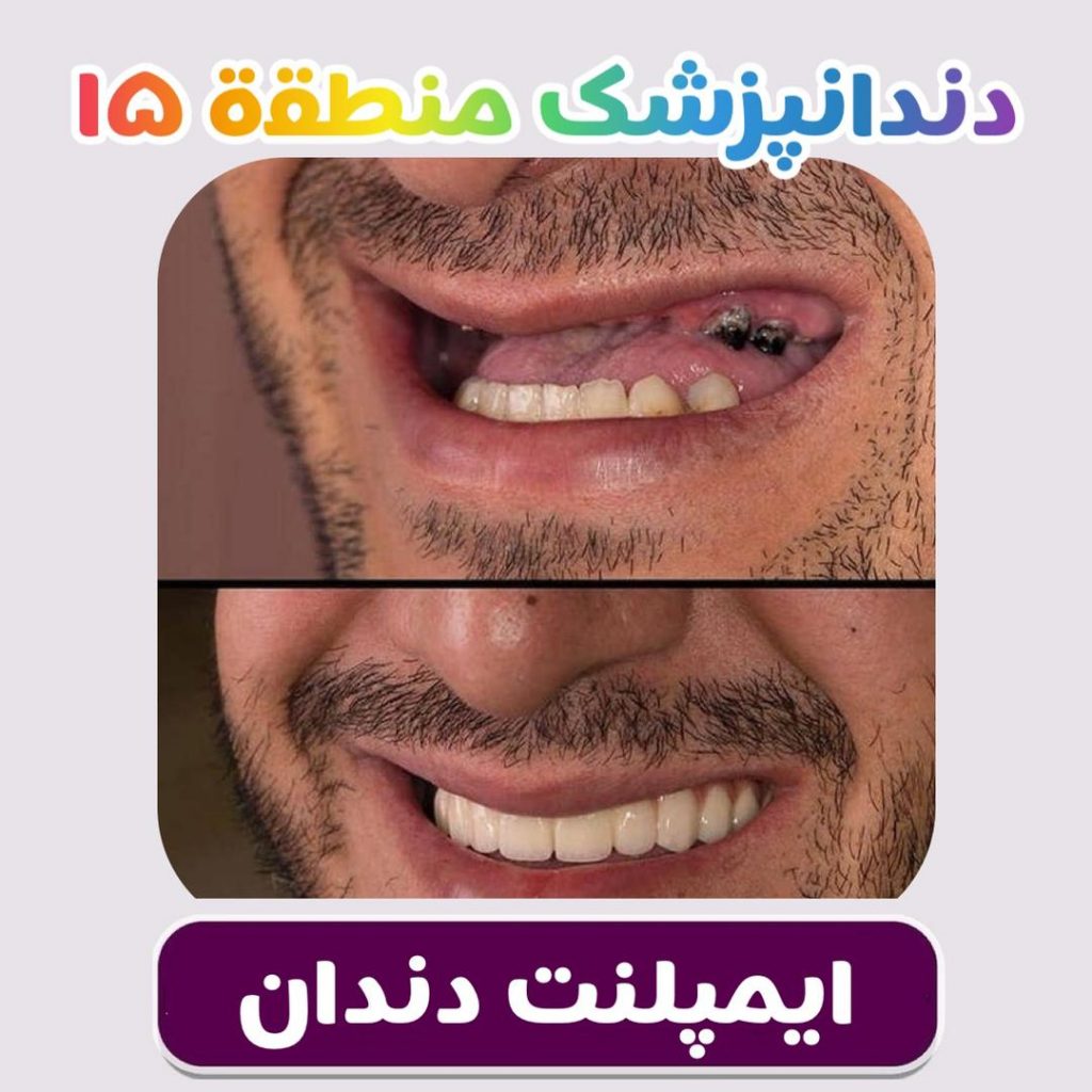 ایمپلنت دندان در منطقه 15 تهران دندانپزشک در منطقه 15 تهران