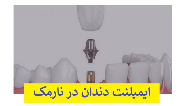 ایمپلنت دندان در نارمک