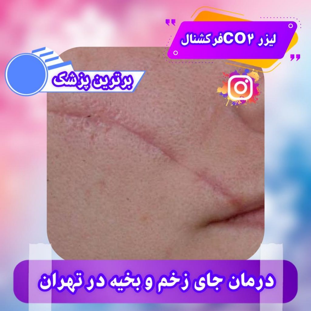 لیزرco2 فرکشنال مرکز درمان جای زخم و بخیه در تهران