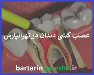 مرکز عصب کشی دندان در تهرانپارس