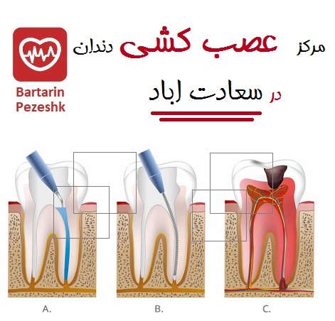 مرکز  عصب کشی دندان در سعادت اباد