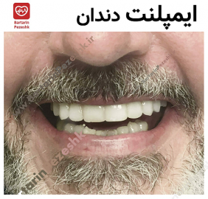 ایمپلنت دندان 3