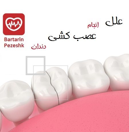 علل انجام عصب کشی دندان 