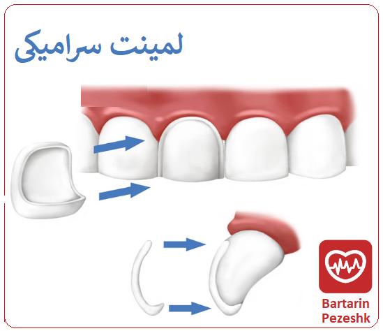 مزایای لمینت دندان در تهران