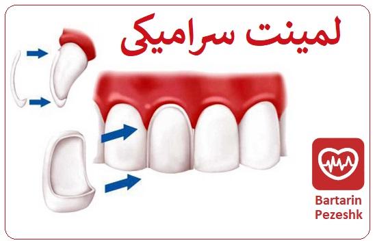 انواع لمینت دندان