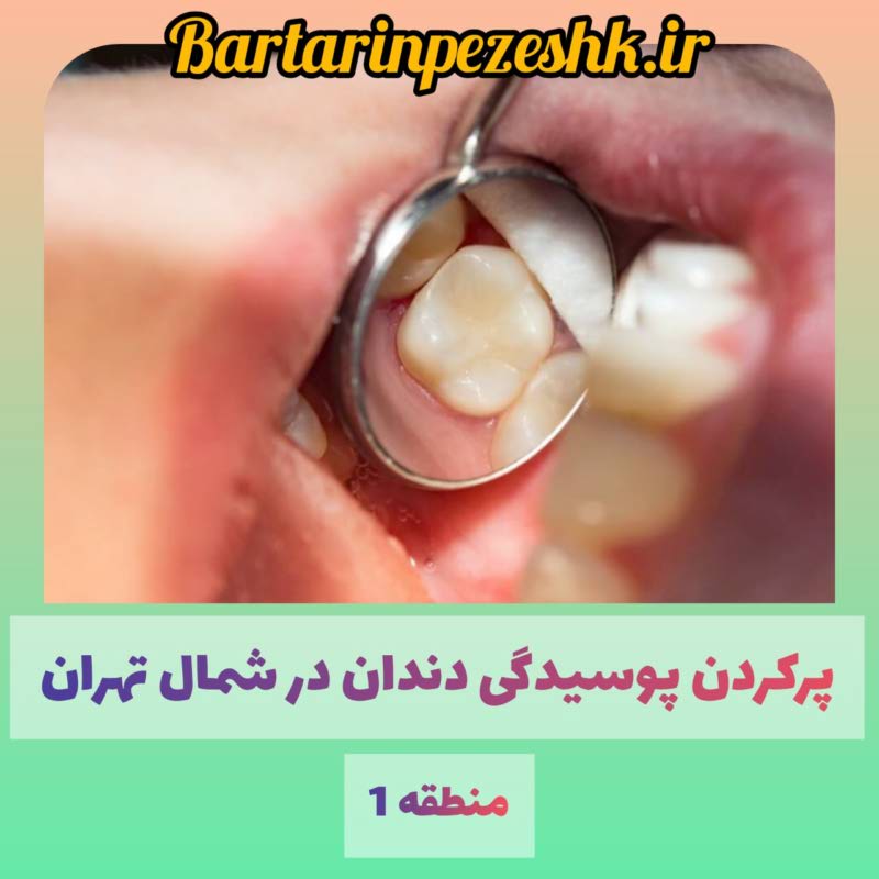 پر کردن پوسیدگی دندان در شمال تهران