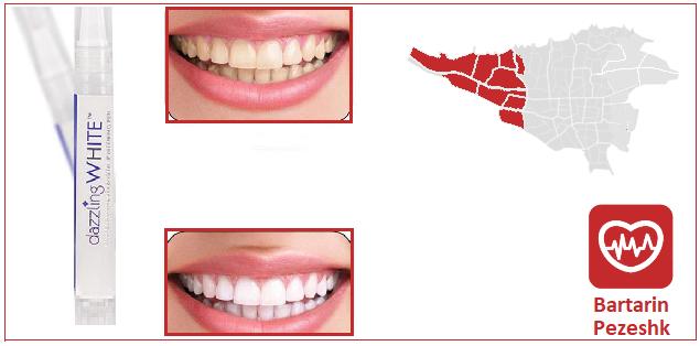 علل تغییر رنگ دندان ها چیست؟