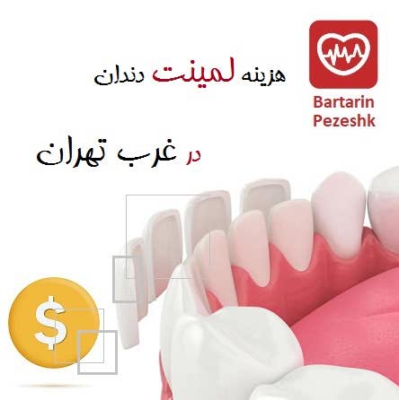 هزینه لمینت دندان در غرب تهران