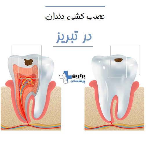 عصب کشی دندان در تبریز