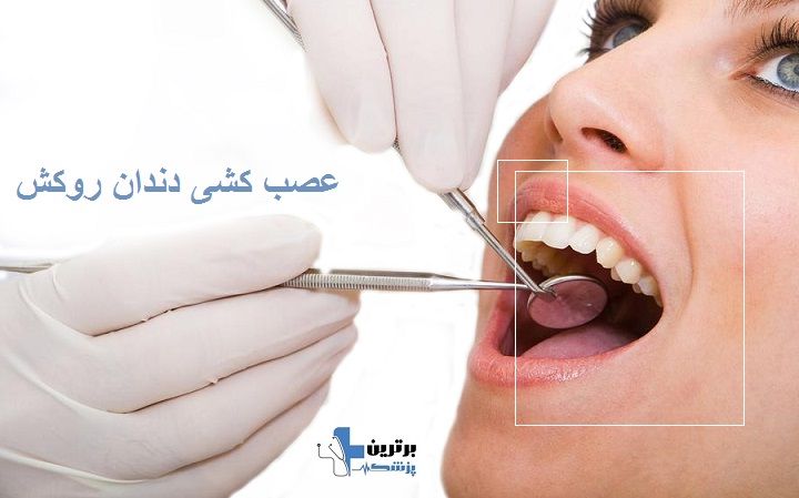 عصب کشی دندان روکش