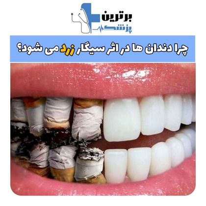 زرد شدن دندان بر اثر سیگار